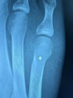 Eight days short of three years. That one stung more than expected. Over a thousand days of showing up, building routine, structure and something that quietly became part of who I am. With the Marathon goal announced yesterday, it was always going to be tough to train at that level while holding a run streak together. The volume, the intensity, the recovery demands. At some point something had to give, and this was it. I am choosing to focus on the positives. The opportunity ahead is huge. A big 2026 goal is now locked in, and that demands a smarter approach, not blind attachment to an old format. Right now the focus is finding alternative ways to train. Swimming, cycling, plenty of time on the Ski Erg. Building fitness without running, keeping the engine ticking over, and staying connected to movement. More than anything, this is about mindset and mental health. The streak was essential for my head. It was my anchor. So the priority now is protecting that feeling through different habits, different sessions, and the same daily commitment to moving forward. The streak has ended. The journey has not!